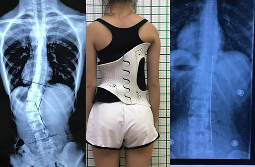 3D打印技術(shù)在骨科的實際應(yīng)用有哪些?(圖4) 3D打印技術(shù)在骨科的實際應(yīng)用有哪些?(圖4)